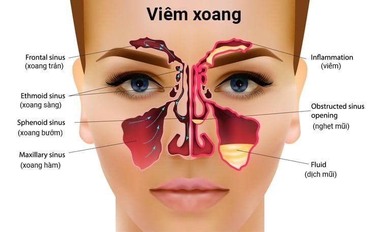 Phân loại viêm xoang theo vị trí các xoang