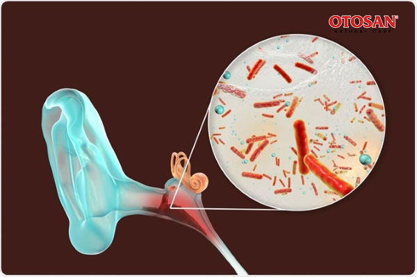 Viêm tai giữa có mủ: Hiểu đúng để điều trị và phòng ngừa