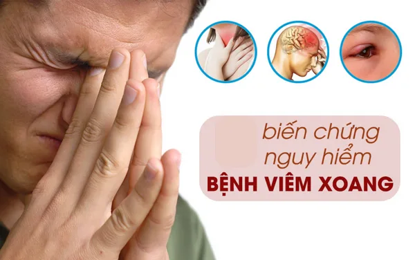 VIÊM XOANG: NGUYÊN NHÂN, TRIỆU CHỨNG & CÁCH ĐIỀU TRỊ VIÊM XOANG HIỆU QUẢ