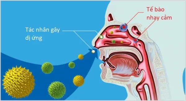 CÁCH PHÂN BIỆT VIÊM MŨI DỊ ỨNG VÀ VIÊM MŨI THÔNG THƯỜNG