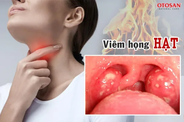 VIÊM HỌNG HẠT: THÔNG TIN CẦN NẮM VÀ CÁCH TRỊ TẠI NHÀ HIỆU QUẢ