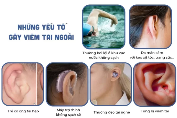 VIÊM TAI NGOÀI CÓ NGUY HIỂM KHÔNG? NHẬN BIẾT TRIỆU CHỨNG, ĐIỀU TRỊ VÀ PHÒNG NGỪA