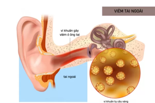 VIÊM TAI NGOÀI CÓ NGUY HIỂM KHÔNG? NHẬN BIẾT TRIỆU CHỨNG, ĐIỀU TRỊ VÀ PHÒNG NGỪA