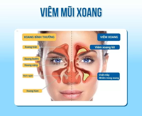 GIẢM VIÊM XOANG HIỆU QUẢ NHỜ RỬA MŨI HÀNG NGÀY